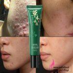 محصولات مراقبت پوست بایزتون baizton کره جنوبی | ضد لک و آکنه