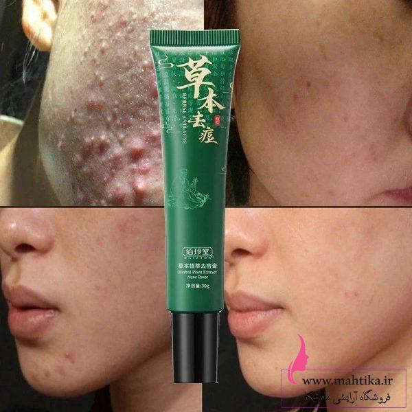 محصولات مراقبت پوست بایزتون baizton کره جنوبی | ضد لک و آکنه