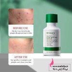 سرم ضد جوش و آکنه سالیسیلیک اسید بیو آکوا