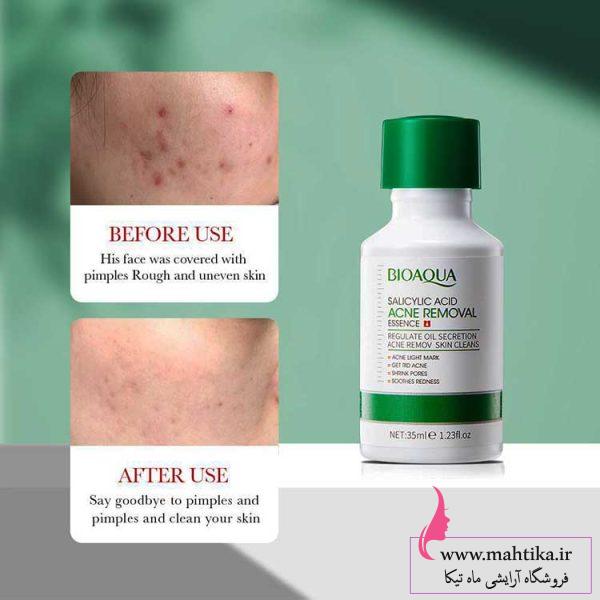 سرم ضد جوش و آکنه سالیسیلیک اسید بیو آکوا
